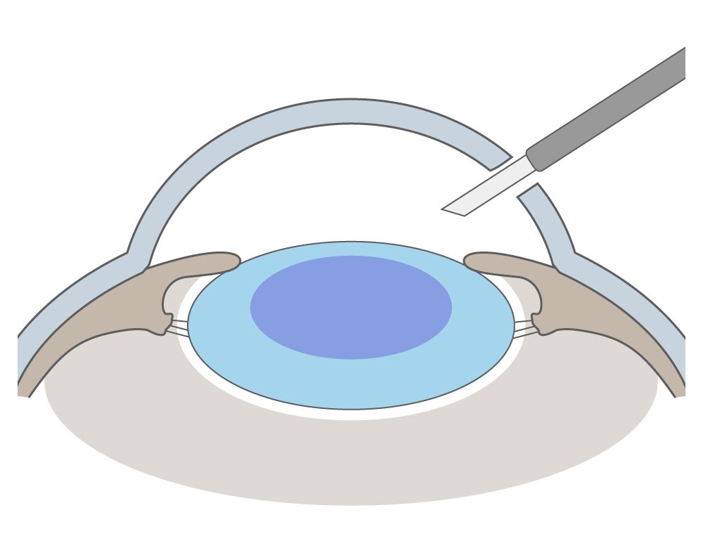 角膜切開のイラスト
