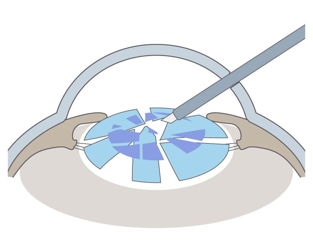 水晶体除去のイラスト