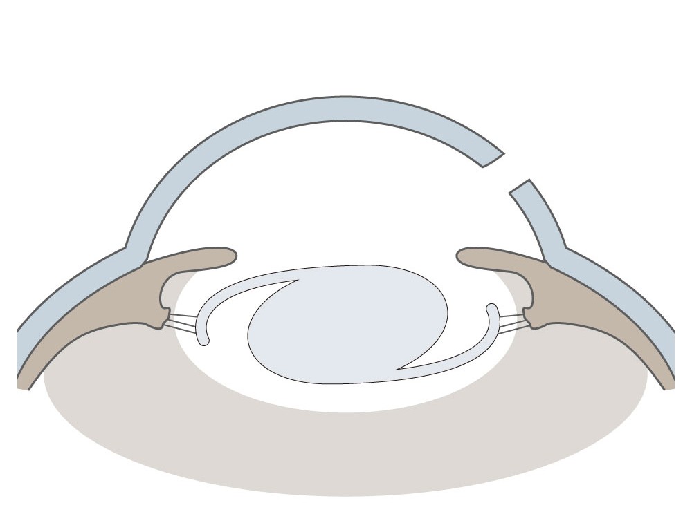 眼内レンズ挿入のイラスト