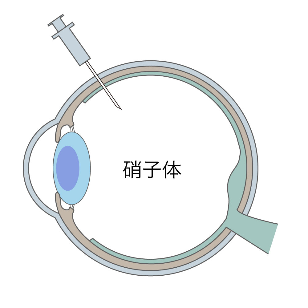 硝子体内注射のイラスト